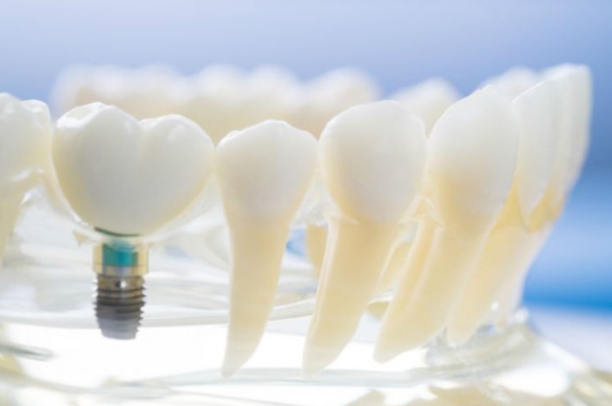 8 Benefits of Dental Implants