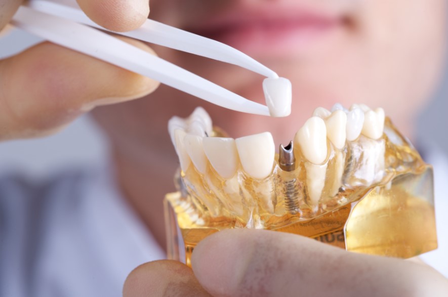 How Dental Implants Can Change Your Life